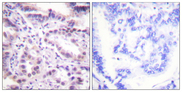 ERF / PE2 Antibody - Immunohistochemistry analysis of paraffin-embedded human lung carcinoma, using ERF (Phospho-Thr526) Antibody. The picture on the right is blocked with the phospho peptide.