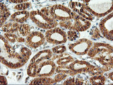 ERGIC-53 / LMAN1 Antibody - IHC of paraffin-embedded Carcinoma of Human thyroid tissue using anti-LMAN1 mouse monoclonal antibody. (Heat-induced epitope retrieval by 10mM citric buffer, pH6.0, 100C for 10min).