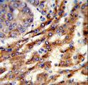 ERGIC3 Antibody - Formalin-fixed and paraffin-embedded human hepatocarcinoma reacted with ERGIC3 Antibody , which was peroxidase-conjugated to the secondary antibody, followed by DAB staining. This data demonstrates the use of this antibody for immunohistochemistry; clinical relevance has not been evaluated.