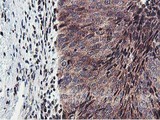 ERI1 / HEXO Antibody - IHC of paraffin-embedded Carcinoma of Human bladder tissue using anti-ERI1 mouse monoclonal antibody.
