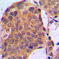 ERK1 + ERK2 Antibody - Immunohistochemical analysis of ERK1/2 staining in human breast cancer formalin fixed paraffin embedded tissue section. The section was pre-treated using heat mediated antigen retrieval with sodium citrate buffer (pH 6.0). The section was then incubated with the antibody at room temperature and detected using an HRP conjugated compact polymer system. DAB was used as the chromogen. The section was then counterstained with hematoxylin and mounted with DPX.