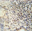 ESRP1 / RBM35A Antibody - ESRP1 antibody immunohistochemistry of formalin-fixed and paraffin-embedded human colon carcinoma followed by peroxidase-conjugated secondary antibody and DAB staining.