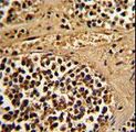 ESRRA / ERR Alpha Antibody - Formalin-fixed and paraffin-embedded human kidney carcinoma reacted with ESRRA Antibody , which was peroxidase-conjugated to the secondary antibody, followed by DAB staining. This data demonstrates the use of this antibody for immunohistochemistry; clinical relevance has not been evaluated.