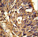 ETFDH Antibody - Formalin-fixed and paraffin-embedded human lung carcinoma reacted with ETFDH Antibody , which was peroxidase-conjugated to the secondary antibody, followed by DAB staining. This data demonstrates the use of this antibody for immunohistochemistry; clinical relevance has not been evaluated.