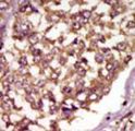 ETK / BMX Antibody - Formalin-fixed and paraffin-embedded human cancer tissue reacted with the primary antibody, which was peroxidase-conjugated to the secondary antibody, followed by AEC staining. This data demonstrates the use of this antibody for immunohistochemistry; clinical relevance has not been evaluated. BC = breast carcinoma; HC = hepatocarcinoma.
