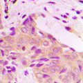 ETK / BMX Antibody - Immunohistochemical analysis of BMX staining in human breast cancer formalin fixed paraffin embedded tissue section. The section was pre-treated using heat mediated antigen retrieval with sodium citrate buffer (pH 6.0). The section was then incubated with the antibody at room temperature and detected using an HRP conjugated compact polymer system. DAB was used as the chromogen. The section was then counterstained with hematoxylin and mounted with DPX.