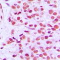 ETS1 / ETS-1 Antibody - Immunohistochemical analysis of ETS1 (pT38) staining in human breast cancer formalin fixed paraffin embedded tissue section. The section was pre-treated using heat mediated antigen retrieval with sodium citrate buffer (pH 6.0). The section was then incubated with the antibody at room temperature and detected using an HRP conjugated compact polymer system. DAB was used as the chromogen. The section was then counterstained with hematoxylin and mounted with DPX.