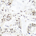 EXO1 Antibody - Immunohistochemistry of paraffin-embedded human gastric cancer tissue.