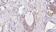 EXOC1 / SEC3 Antibody - 1:100 staining human liver carcinoma tissues by IHC-P. The sample was formaldehyde fixed and a heat mediated antigen retrieval step in citrate buffer was performed. The sample was then blocked and incubated with the antibody for 1.5 hours at 22°C. An HRP conjugated goat anti-rabbit antibody was used as the secondary.