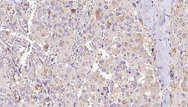 EXOC3 / SEC6 Antibody - 1:100 staining human thyroid carcinoma tissue by IHC-P. The sample was formaldehyde fixed and a heat mediated antigen retrieval step in citrate buffer was performed. The sample was then blocked and incubated with the antibody for 1.5 hours at 22°C. An HRP conjugated goat anti-rabbit antibody was used as the secondary.