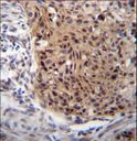 EXTL3 Antibody - EXTL3 Antibody immunohistochemistry of formalin-fixed and paraffin-embedded human esophageal carcinoma followed by peroxidase-conjugated secondary antibody and DAB staining.