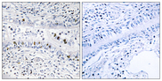 EZH1 / ENX-2 Antibody - Immunohistochemistry analysis of paraffin-embedded human lung carcinoma tissue, using EZH1 Antibody. The picture on the right is blocked with the synthesized peptide.