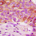 EZR / Ezrin Antibody - Immunohistochemical analysis of Ezrin (pT567) staining in human breast cancer formalin fixed paraffin embedded tissue section. The section was pre-treated using heat mediated antigen retrieval with sodium citrate buffer (pH 6.0). The section was then incubated with the antibody at room temperature and detected using an HRP conjugated compact polymer system. DAB was used as the chromogen. The section was then counterstained with hematoxylin and mounted with DPX.