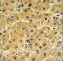 F10 / Factor X Antibody - F10 Antibody IHC of formalin-fixed and paraffin-embedded human hepatocarcinoma followed by peroxidase-conjugated secondary antibody and DAB staining.