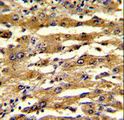 FABP3 / H-FABP Antibody - Formalin-fixed and paraffin-embedded human hepatocarcinoma with FABP3 Antibody , which was peroxidase-conjugated to the secondary antibody, followed by DAB staining. This data demonstrates the use of this antibody for immunohistochemistry; clinical relevance has not been evaluated.