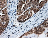 FAHD2A Antibody - IHC of paraffin-embedded Adenocarcinoma of ovary tissue using anti-FAHD2A mouse monoclonal antibody. (Dilution 1:50).