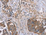 FAIM2 / LIFEGUARD Antibody - Immunohistochemistry of paraffin-embedded Human cervical cancer using FAIM2 Polyclonal Antibody at dilution of 1:30.