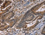 FAM107A / TU3A Antibody - Immunohistochemistry of paraffin-embedded Human colon cancer using FAM107A Polyclonal Antibody at dilution of 1:30.