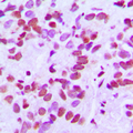 FAM111B Antibody - Immunohistochemical analysis of CANP staining in human breast cancer formalin fixed paraffin embedded tissue section. The section was pre-treated using heat mediated antigen retrieval with sodium citrate buffer (pH 6.0). The section was then incubated with the antibody at room temperature and detected using an HRP conjugated compact polymer system. DAB was used as the chromogen. The section was then counterstained with hematoxylin and mounted with DPX.