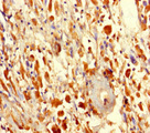 Fam114a2 Antibody - Immunohistochemistry of paraffin-embedded human melanoma using FAM114A2 Antibody at dilution of 1:100