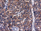 FAM127C Antibody - IHC of paraffin-embedded Adenocarcinoma of Human ovary tissue using anti-FAM127C mouse monoclonal antibody.