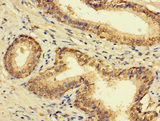 FAM135B Antibody - Immunohistochemistry of paraffin-embedded human prostate cancer using FAM135B Antibody at dilution of 1:100