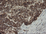 FAM164A / CGI-62 Antibody - IHC of paraffin-embedded Adenocarcinoma of Human ovary tissue using anti-FAM164A mouse monoclonal antibody.