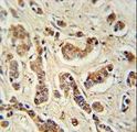 FAM20A Antibody - FA20A Antibody immunohistochemistry of formalin-fixed and paraffin-embedded human breast carcinoma tissue followed by peroxidase-conjugated secondary antibody and DAB staining.