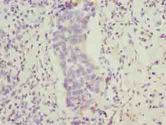FAM222B Antibody - Immunohistochemistry of paraffin-embedded human bladder carcinoma using antibody at dilution of 1:100.