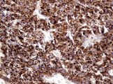 FAM234A Antibody - IHC of paraffin-embedded Carcinoma of Human liver tissue using anti-ITFG3 mouse monoclonal antibody.