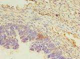 FAM32A Antibody - Immunohistochemistry of paraffin-embedded human ovarian cancer using antibody at dilution of 1:100.