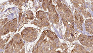 FAM3D Antibody - 1:100 staining human Melanoma tissue by IHC-P. The sample was formaldehyde fixed and a heat mediated antigen retrieval step in citrate buffer was performed. The sample was then blocked and incubated with the antibody for 1.5 hours at 22°C. An HRP conjugated goat anti-rabbit antibody was used as the secondary.