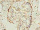 FAM53B Antibody - Immunohistochemistry of paraffin-embedded human breast cancer using antibody at dilution of 1:100.