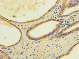FAM70B Antibody - Immunohistochemistry of paraffin-embedded human prostate cancer using TMEM255B Antibody at dilution of 1:100