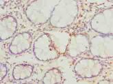 FAM82B Antibody - Immunohistochemistry of paraffin-embedded human colon cancer using antibody at dilution of 1:100.