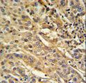 FAM91A1 Antibody - F91A1 Antibody IHC of formalin-fixed and paraffin-embedded human cervix carcinoma followed by peroxidase-conjugated secondary antibody and DAB staining.