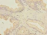 FAM92A1 Antibody - Immunohistochemistry of paraffin-embedded human prostate cancer using antibody at dilution of 1:100.