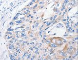 FANCF Antibody - Immunohistochemistry of paraffin-embedded Human esophagus cancer using FANCF Polyclonal Antibody at dilution of 1:100.