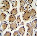 FAT10 / UBD Antibody - FAT10 Antibody immunohistochemistry of formalin-fixed and paraffin-embedded human stomach carcinoma followed by peroxidase-conjugated secondary antibody and DAB staining.