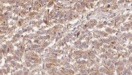 FBLN1 / Fibulin 1 Antibody - 1:100 staining human Melanoma tissue by IHC-P. The sample was formaldehyde fixed and a heat mediated antigen retrieval step in citrate buffer was performed. The sample was then blocked and incubated with the antibody for 1.5 hours at 22°C. An HRP conjugated goat anti-rabbit antibody was used as the secondary.