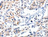 FBLN5 / Fibulin 5 Antibody - Immunohistochemistry of paraffin-embedded Human lung cancer using FBLN5 Polyclonal Antibody at dilution of 1:85.
