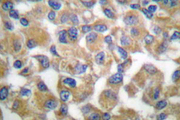 FBN1 / Fibrillin 1 Antibody - IHCanalysis of Fibrillin-1 (N2843) pAb in paraffin-embedded human breast carcinoma tissue.