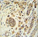FBXL15 Antibody - FBXL15 Antibody immunohistochemistry of formalin-fixed and paraffin-embedded human breast carcinoma followed by peroxidase-conjugated secondary antibody and DAB staining.