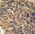 FBXL2 Antibody - FBXL2 Antibody IHC of formalin-fixed and paraffin-embedded human lung carcinoma followed by peroxidase-conjugated secondary antibody and DAB staining.