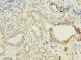 FBXO28 Antibody - Immunohistochemistry of paraffin-embedded human breast cancer using antibody at dilution of 1:100.