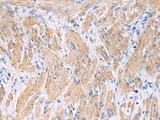 FBXO45 Antibody - Immunohistochemistry of paraffin-embedded Human gastric cancer tissue  using FBXO45 Polyclonal Antibody at dilution of 1:40(×200)