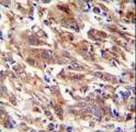 FBXW12 Antibody - FBXW12 antibody immunohistochemistry of formalin-fixed and paraffin-embedded human breast carcinoma followed by peroxidase-conjugated secondary antibody and DAB staining.