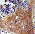 FBXW8 Antibody - FBXW8 Antibody immunohistochemistry of formalin-fixed and paraffin-embedded human lung carcinoma followed by peroxidase-conjugated secondary antibody and DAB staining.