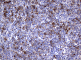 FCER2 / CD23 Antibody - IHC of paraffin-embedded Human lymphoma tissue using anti-FCER2 mouse monoclonal antibody.
