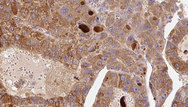 FcERI / Fc Epsilon RI Antibody - 1:100 staining human liver carcinoma tissues by IHC-P. The sample was formaldehyde fixed and a heat mediated antigen retrieval step in citrate buffer was performed. The sample was then blocked and incubated with the antibody for 1.5 hours at 22°C. An HRP conjugated goat anti-rabbit antibody was used as the secondary.